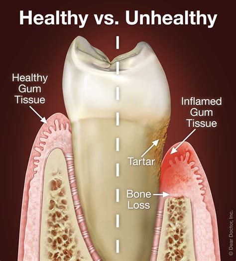Periodontal (Gum) Disease .